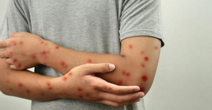 OPS emitió alerta ante el aumento de casos de sarampión en las Américas